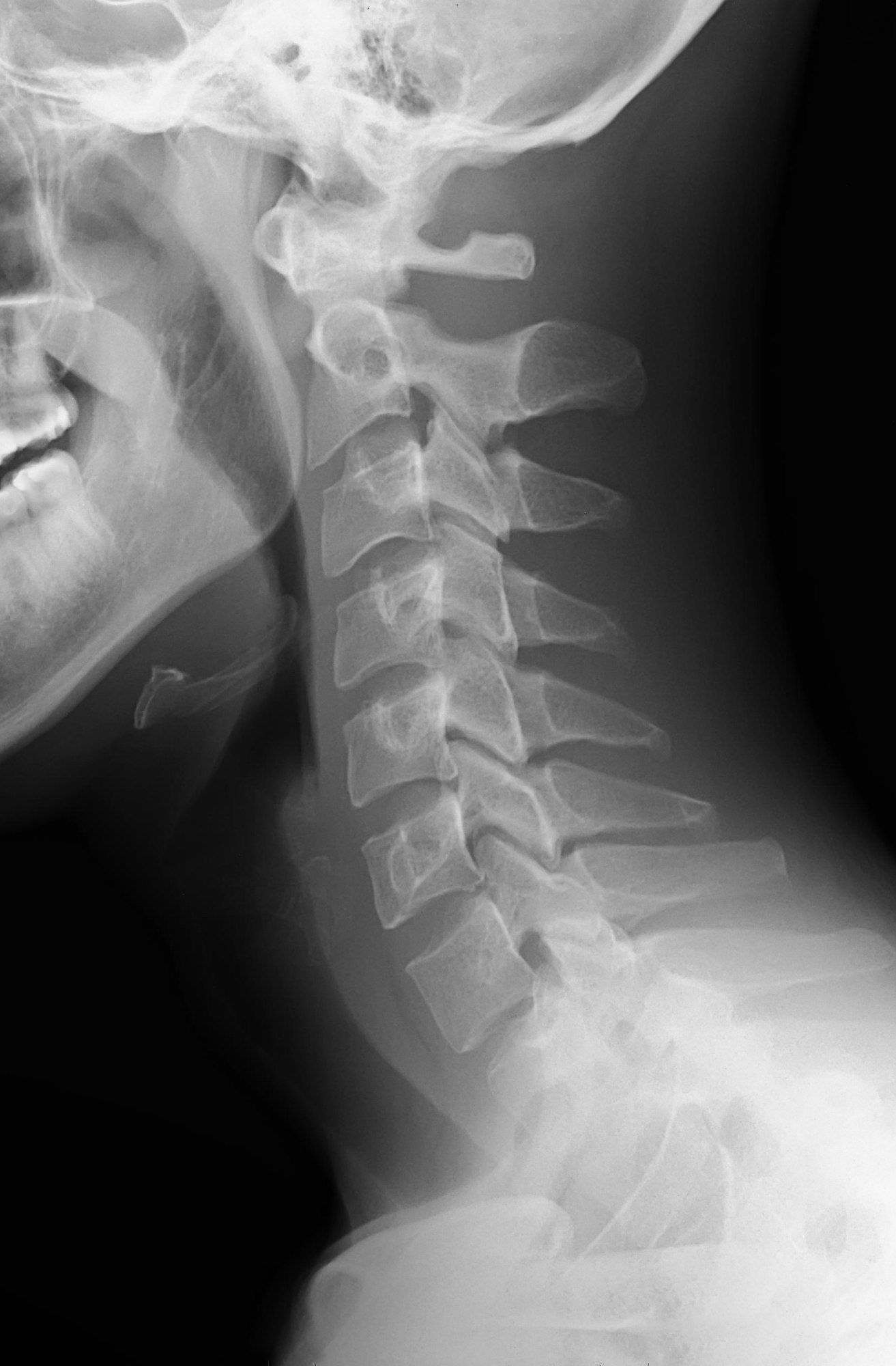 Chiropractor Hamilton Mill, GA - UCC GA